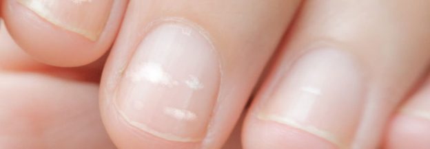 определение болезней по ногтям